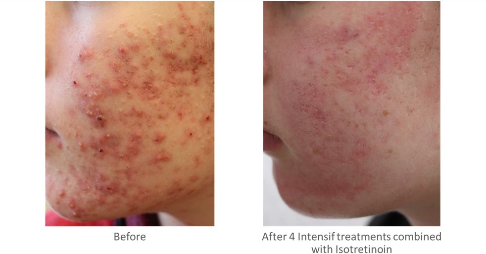 Pore Refinement and Skin Tightening Before and After